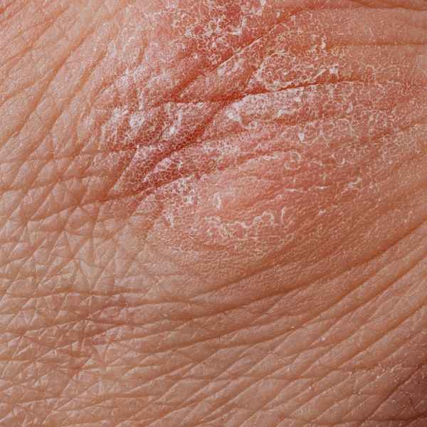 damaged skin